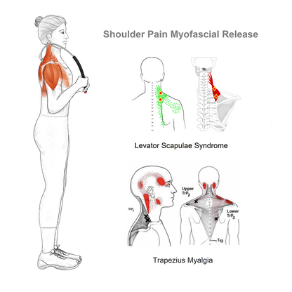 Levator Scapulae Syndrome Relief